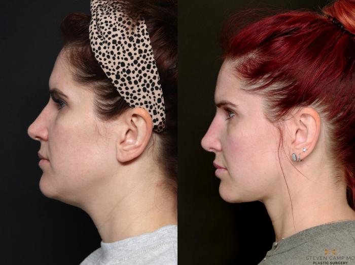 Before & After Necklift Case 689 Left Side View in Fort Worth & Arlington, Texas