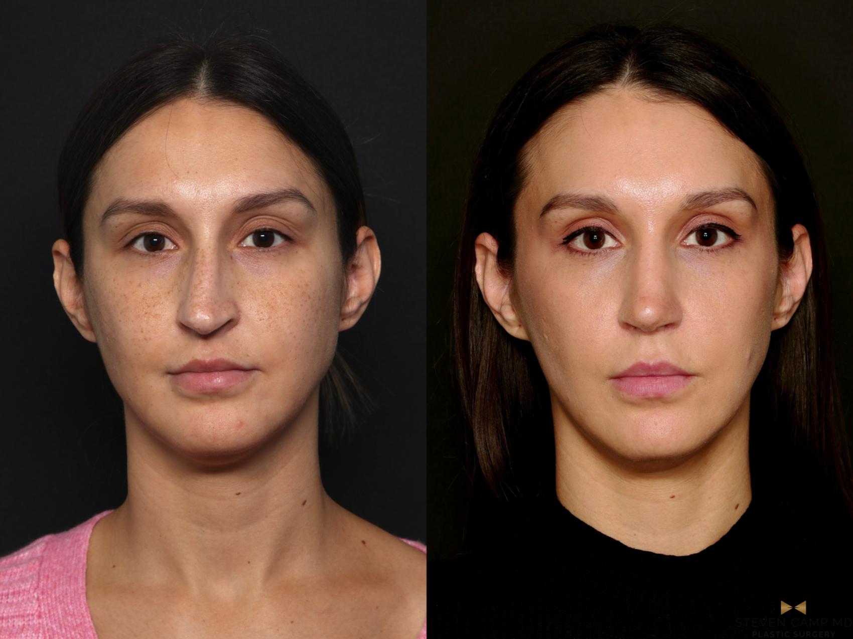 Before & After Rhinoplasty Case 724 Front View in Fort Worth & Arlington, Texas