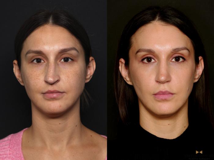 Before & After Rhinoplasty Case 724 Front View in Fort Worth & Arlington, Texas
