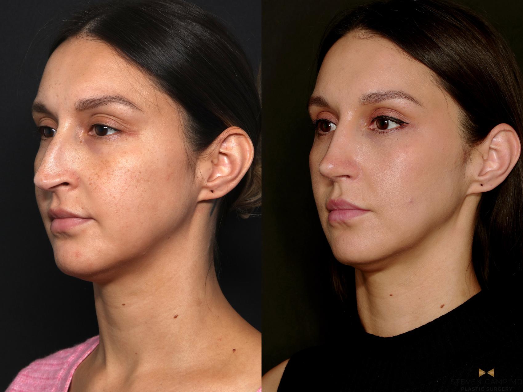 Before & After Rhinoplasty Case 724 Left Oblique View in Fort Worth & Arlington, Texas