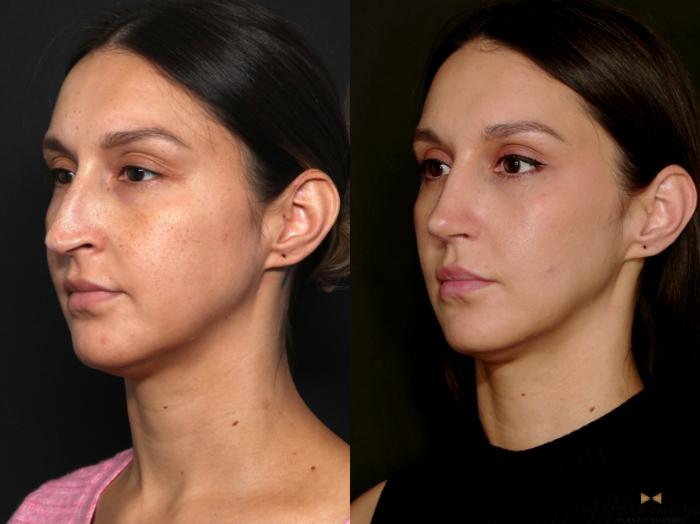 Before & After Rhinoplasty Case 724 Left Oblique View in Fort Worth & Arlington, Texas