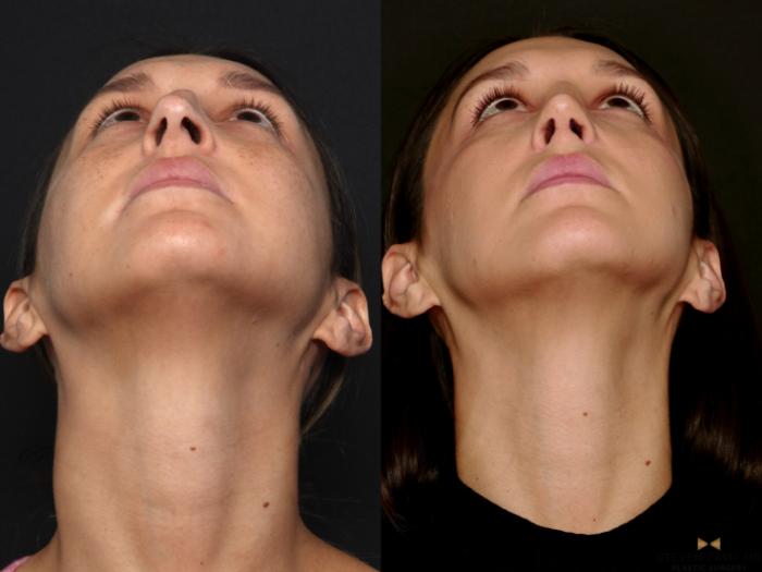 Before & After Rhinoplasty Case 724 Looking up View in Fort Worth & Arlington, Texas