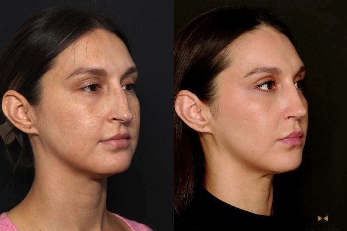 Before & After Rhinoplasty Case 724 Right Oblique View in Fort Worth & Arlington, Texas