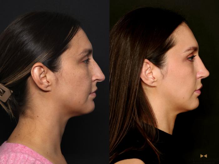 Before & After Rhinoplasty Case 724 Right Side View in Fort Worth & Arlington, Texas