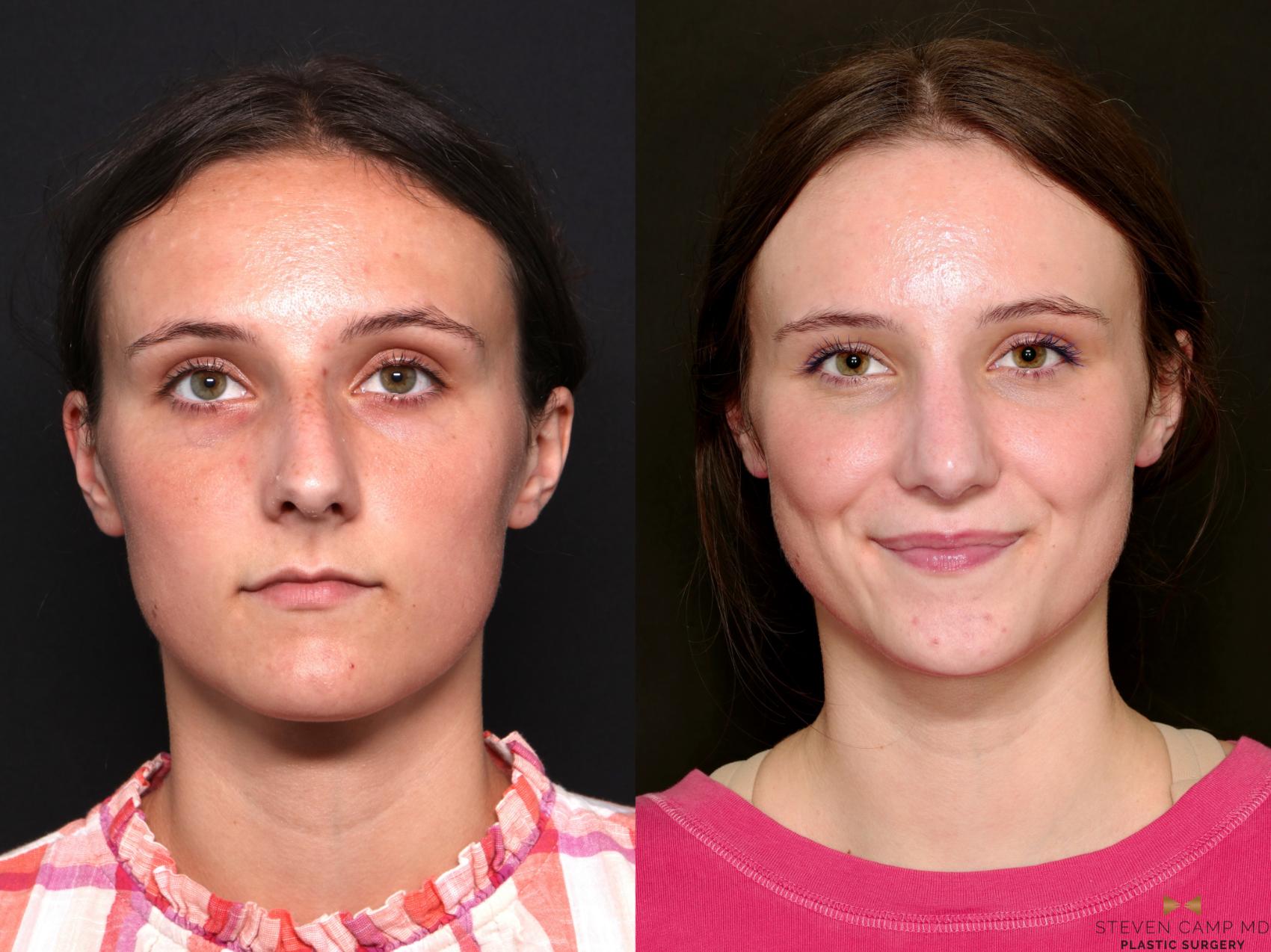 Before & After Rhinoplasty Case 740 Front View in Fort Worth & Arlington, Texas