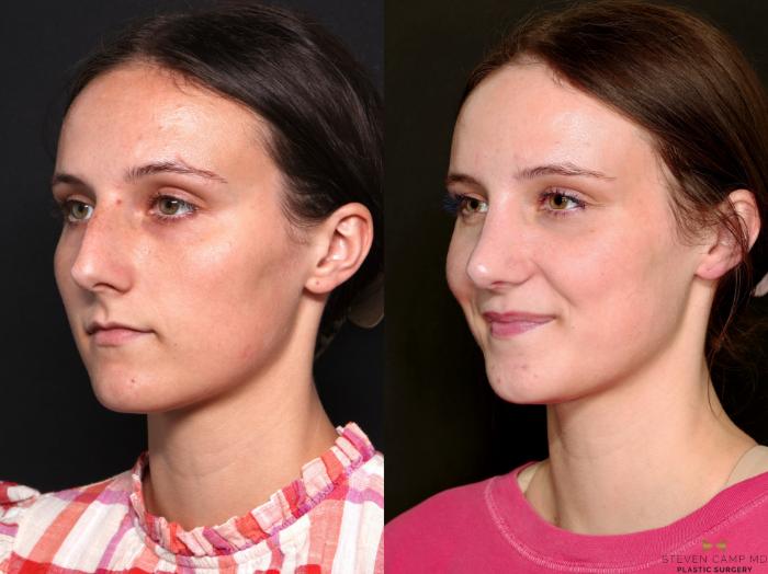 Before & After Rhinoplasty Case 740 Left Oblique View in Fort Worth & Arlington, Texas