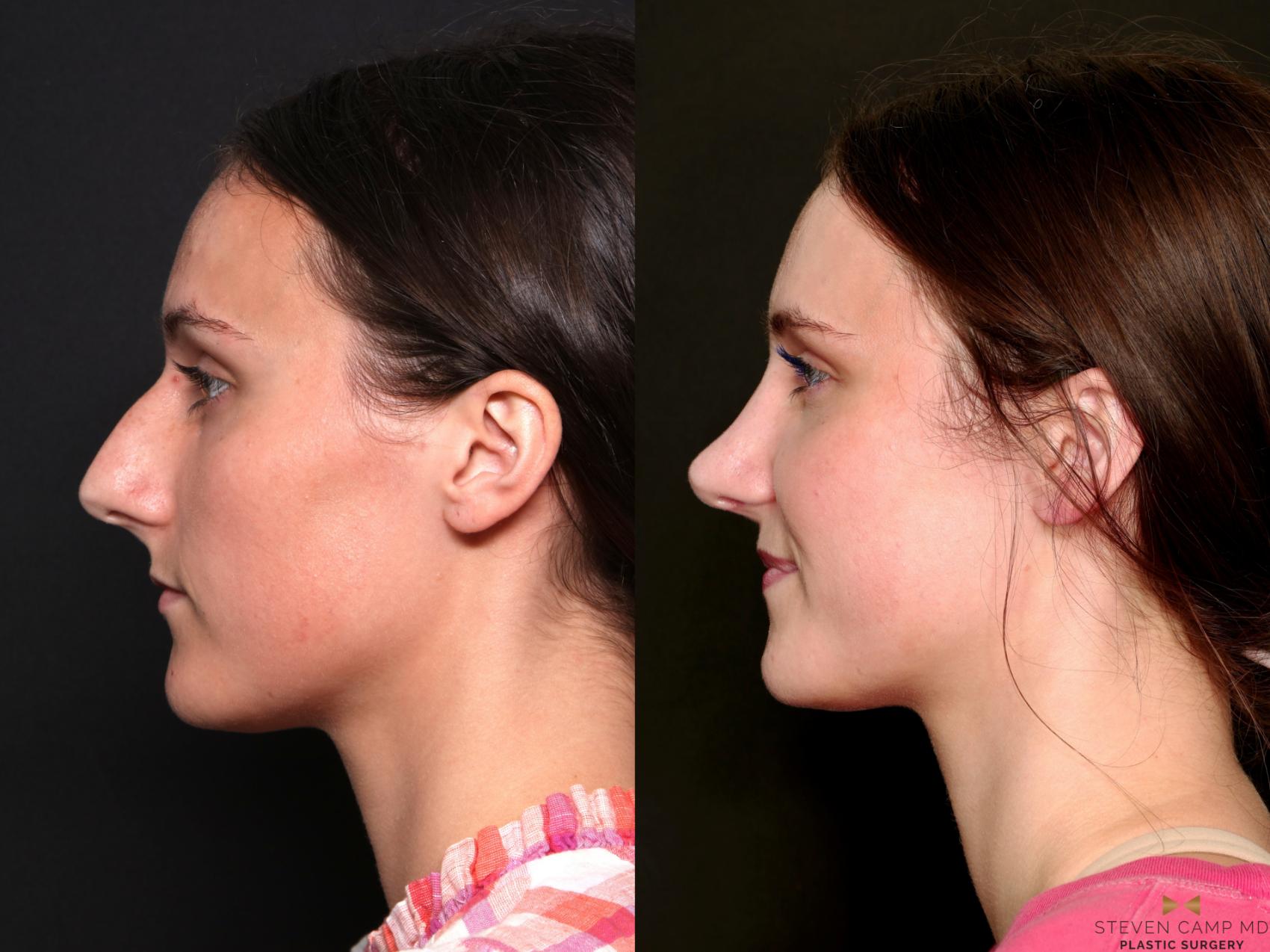 Before & After Rhinoplasty Case 740 Left Side View in Fort Worth & Arlington, Texas