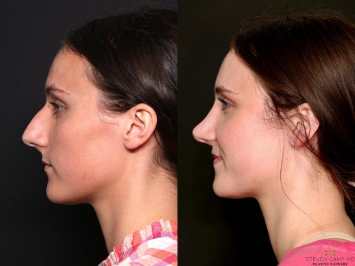 Before & After Rhinoplasty Case 740 Left Side View in Fort Worth & Arlington, Texas