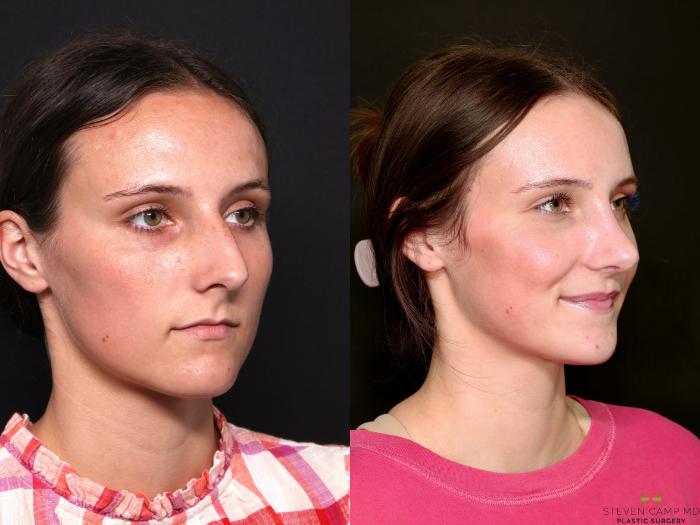 Before & After Rhinoplasty Case 740 Right Oblique View in Fort Worth & Arlington, Texas