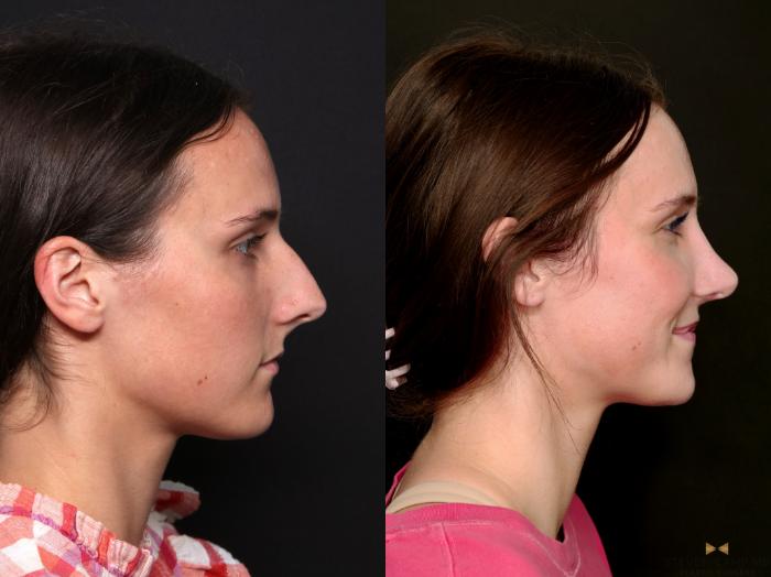 Before & After Rhinoplasty Case 740 Right Side View in Fort Worth & Arlington, Texas