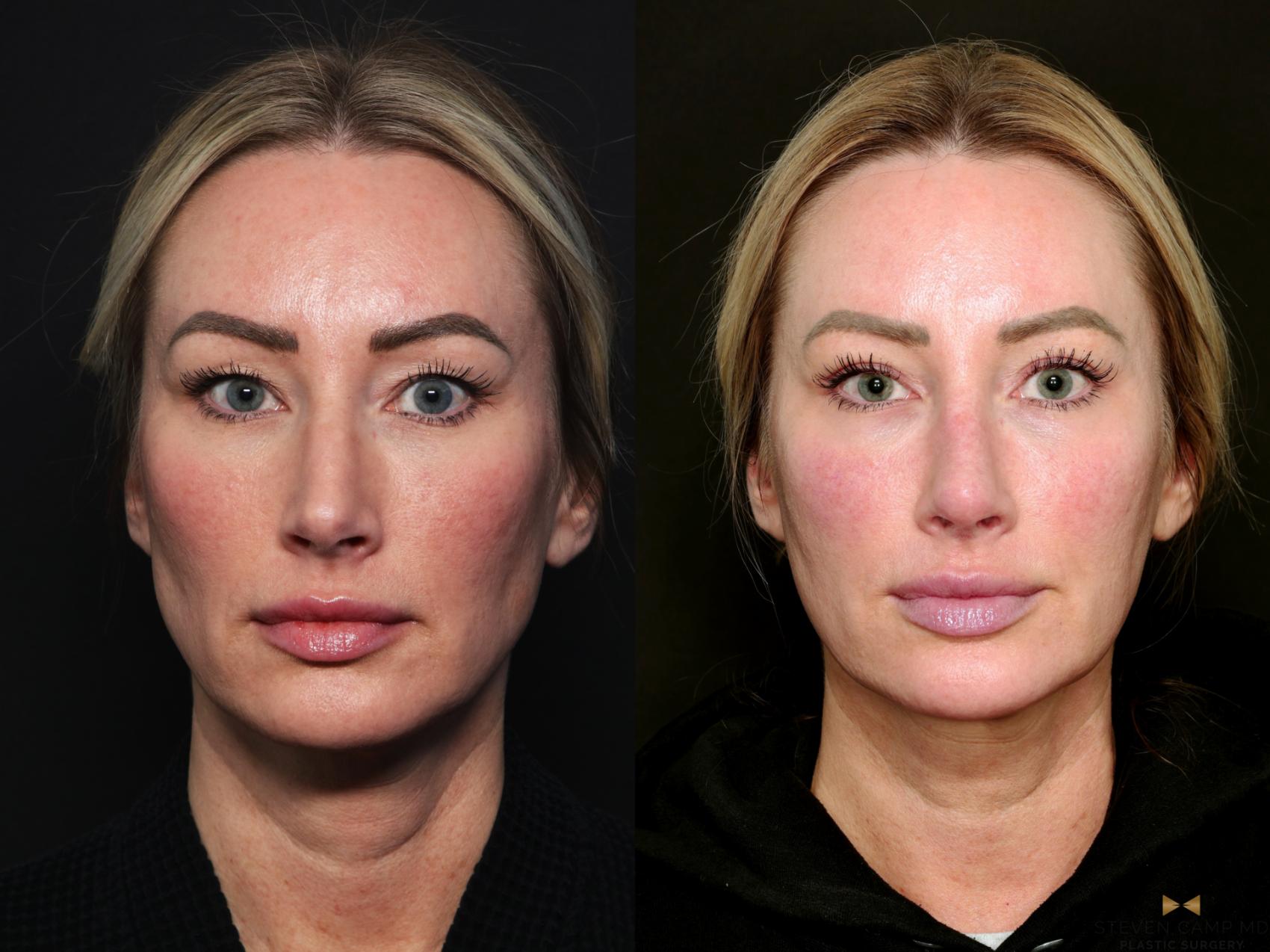 Before & After Blepharoplasty Case 741 Front View in Fort Worth & Arlington, Texas