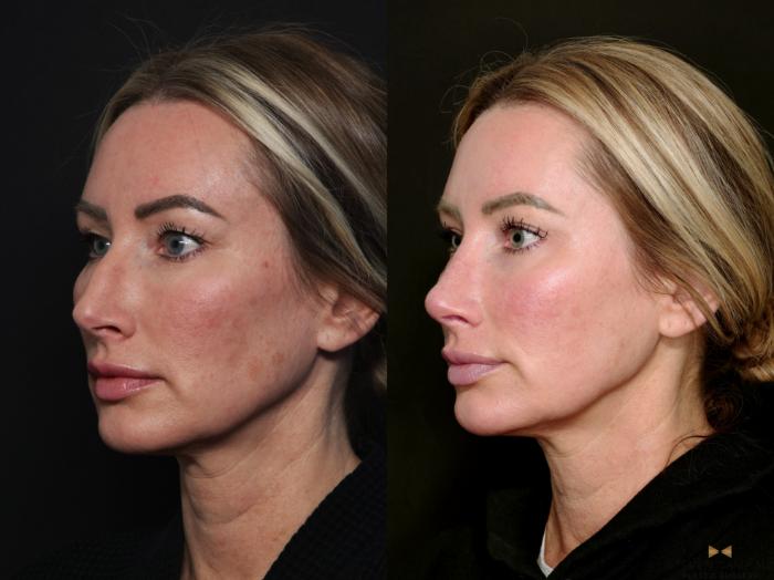 Before & After Blepharoplasty Case 741 Left Oblique View in Fort Worth & Arlington, Texas
