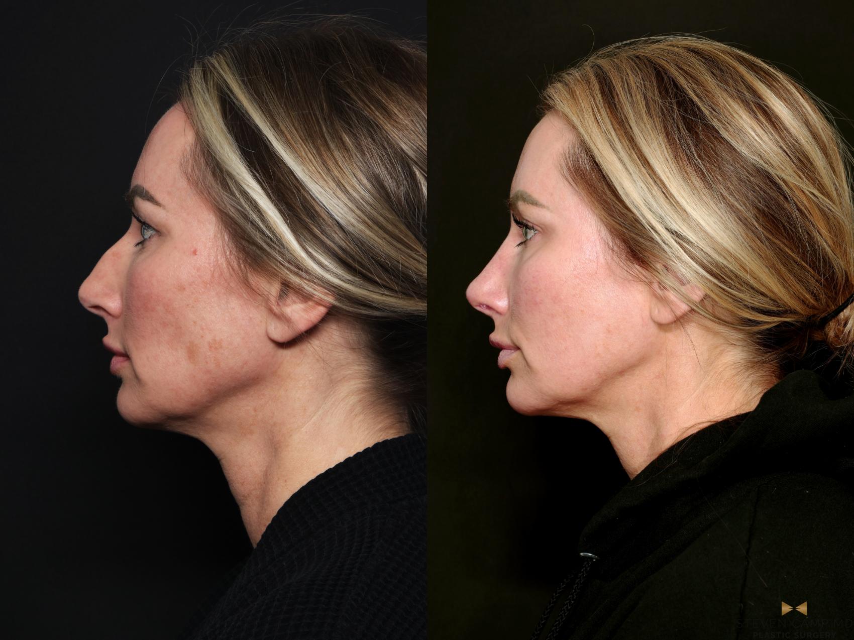 Before & After Blepharoplasty Case 741 Left Side View in Fort Worth & Arlington, Texas