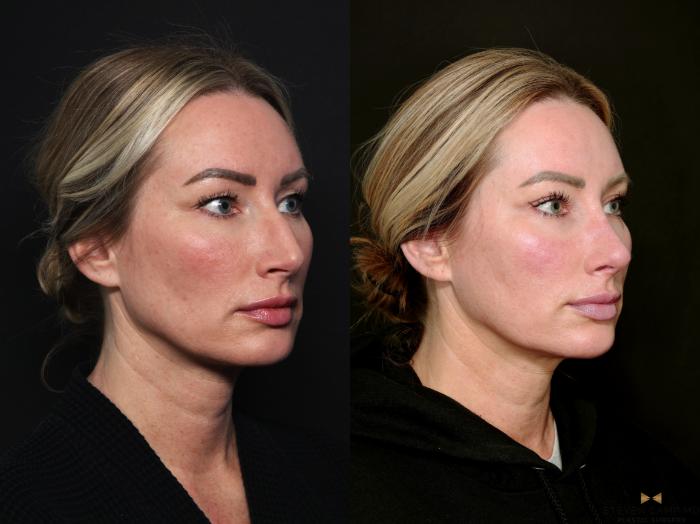 Before & After Blepharoplasty Case 741 Right Oblique View in Fort Worth & Arlington, Texas