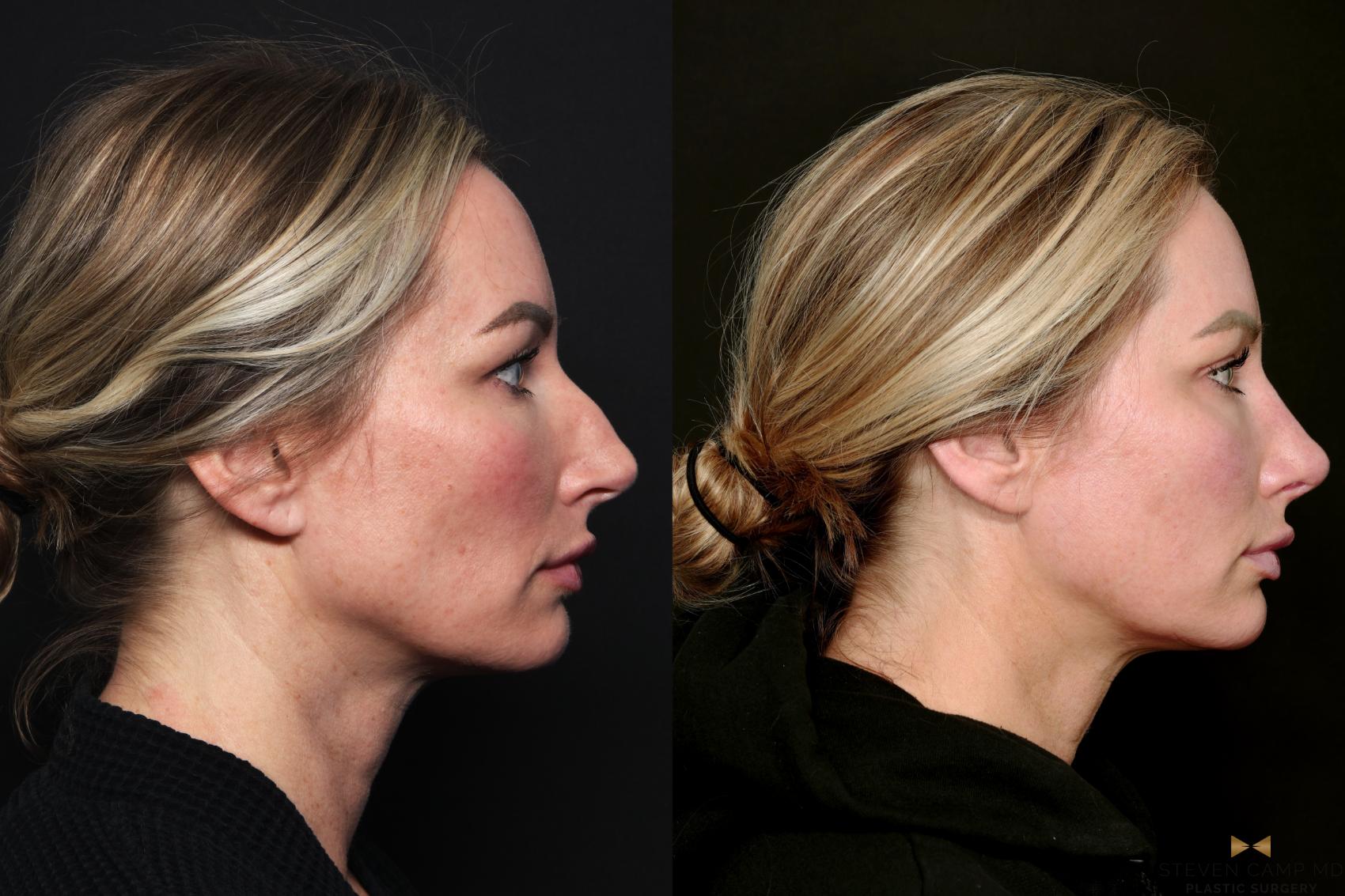 Before & After Blepharoplasty Case 741 Right Side View in Fort Worth & Arlington, Texas