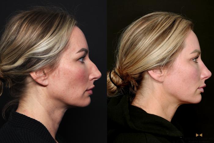 Before & After Blepharoplasty Case 741 Right Side View in Fort Worth & Arlington, Texas