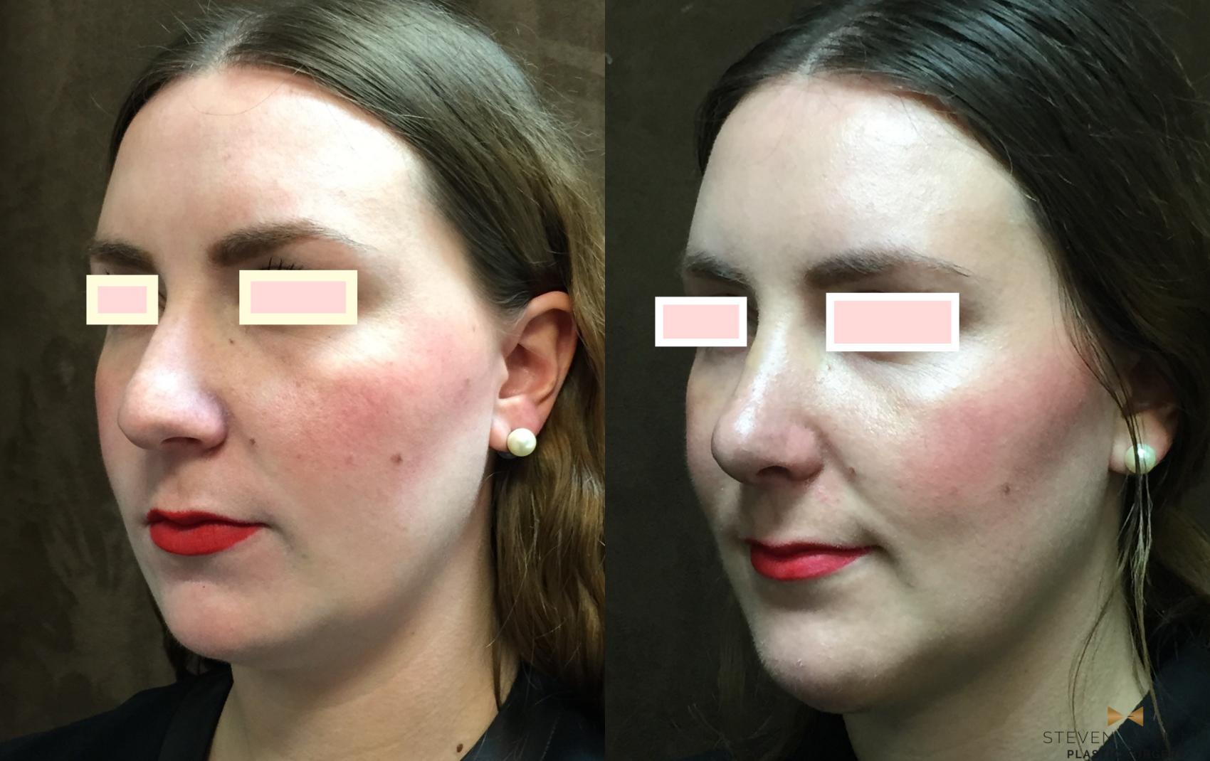 Before & After Rhinoplasty Case 80 View #1 View in Fort Worth, Texas