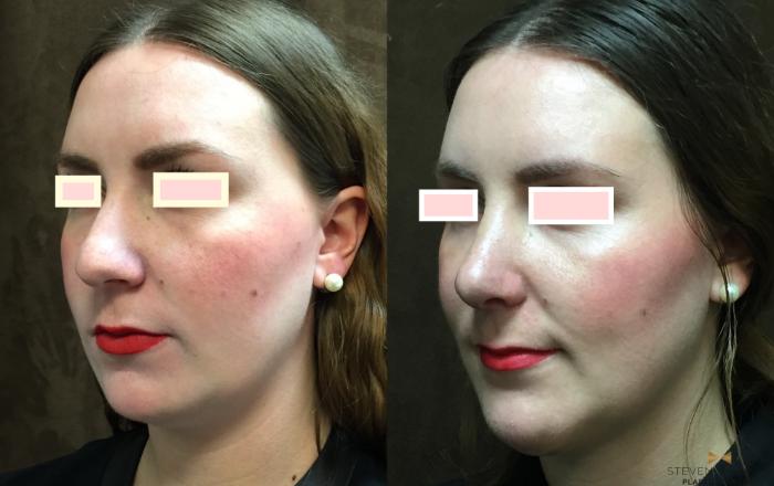 Before & After Rhinoplasty Case 80 View #1 View in Fort Worth & Arlington, Texas
