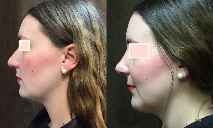 Before & After Rhinoplasty Case 80 View #2 View in Fort Worth & Arlington, Texas