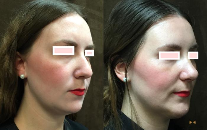 Before & After Rhinoplasty Case 80 View #4 View in Fort Worth & Arlington, Texas