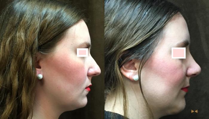 Before & After Rhinoplasty Case 80 View #5 View in Fort Worth & Arlington, Texas