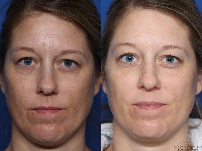 Before & After Sciton Laser Case 334 Front View in Fort Worth & Arlington, Texas