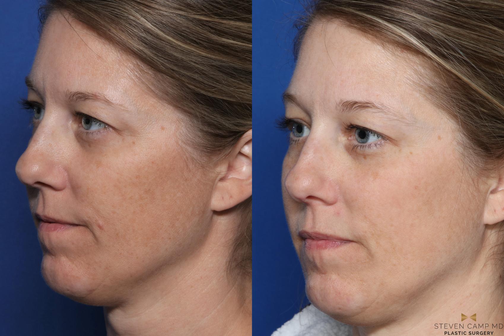 Before & After Sciton Laser Case 334 Left Oblique View in Fort Worth, Texas