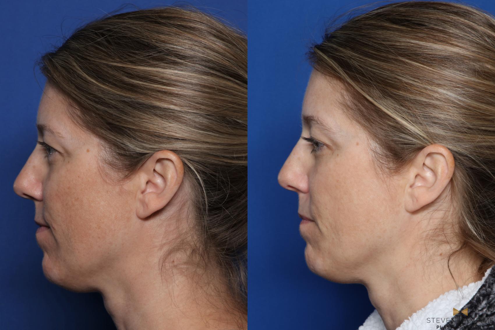 Before & After Sciton Laser Case 334 Left Side View in Fort Worth, Texas