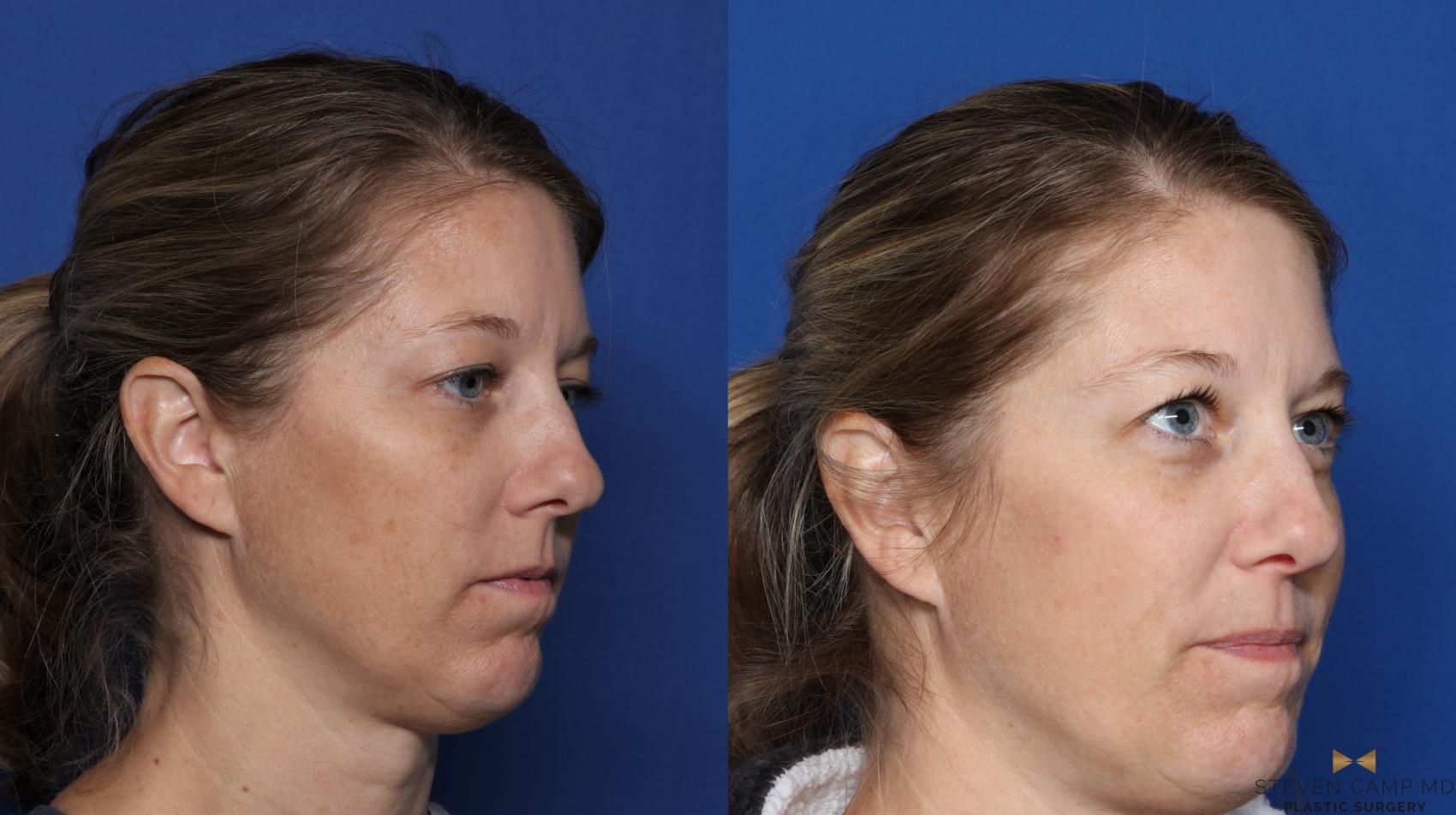 Before & After Sciton Laser Case 334 Right Oblique View in Fort Worth, Texas