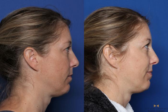 Before & After Sciton Laser Case 334 Right Side View in Fort Worth, Texas