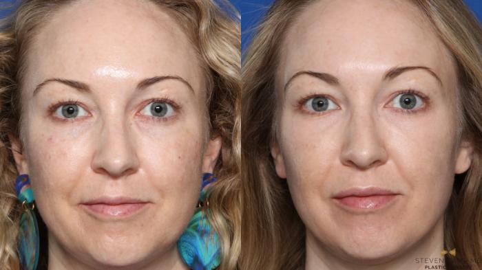 Before & After Sciton Laser Case 336 Front View in Fort Worth, Texas