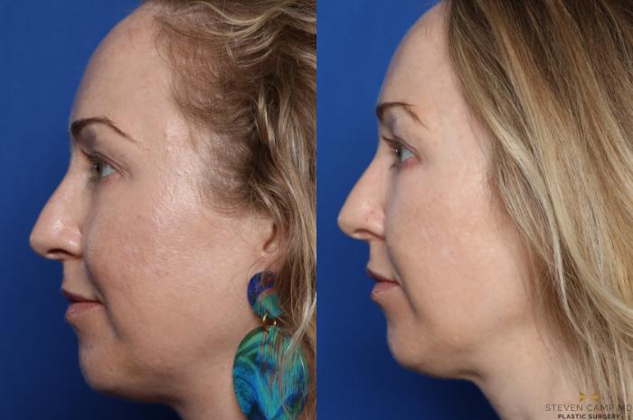 Before & After Sciton Laser Case 336 Left Side View in Fort Worth, Texas