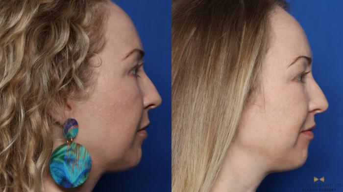 Before & After Sciton Laser Case 336 Right Side View in Fort Worth, Texas