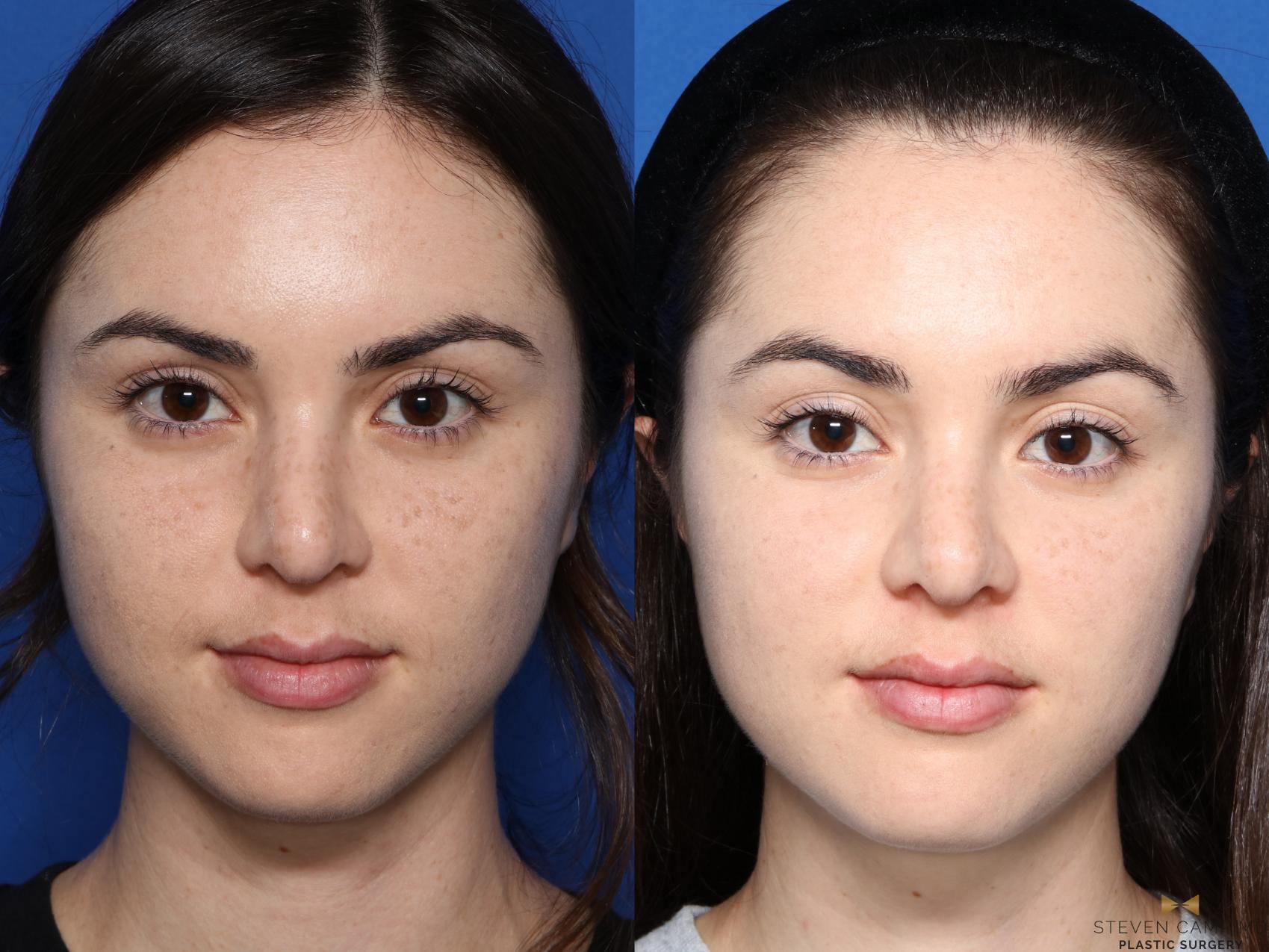 Before & After Sciton Laser Case 337 Front View in Fort Worth & Arlington, Texas