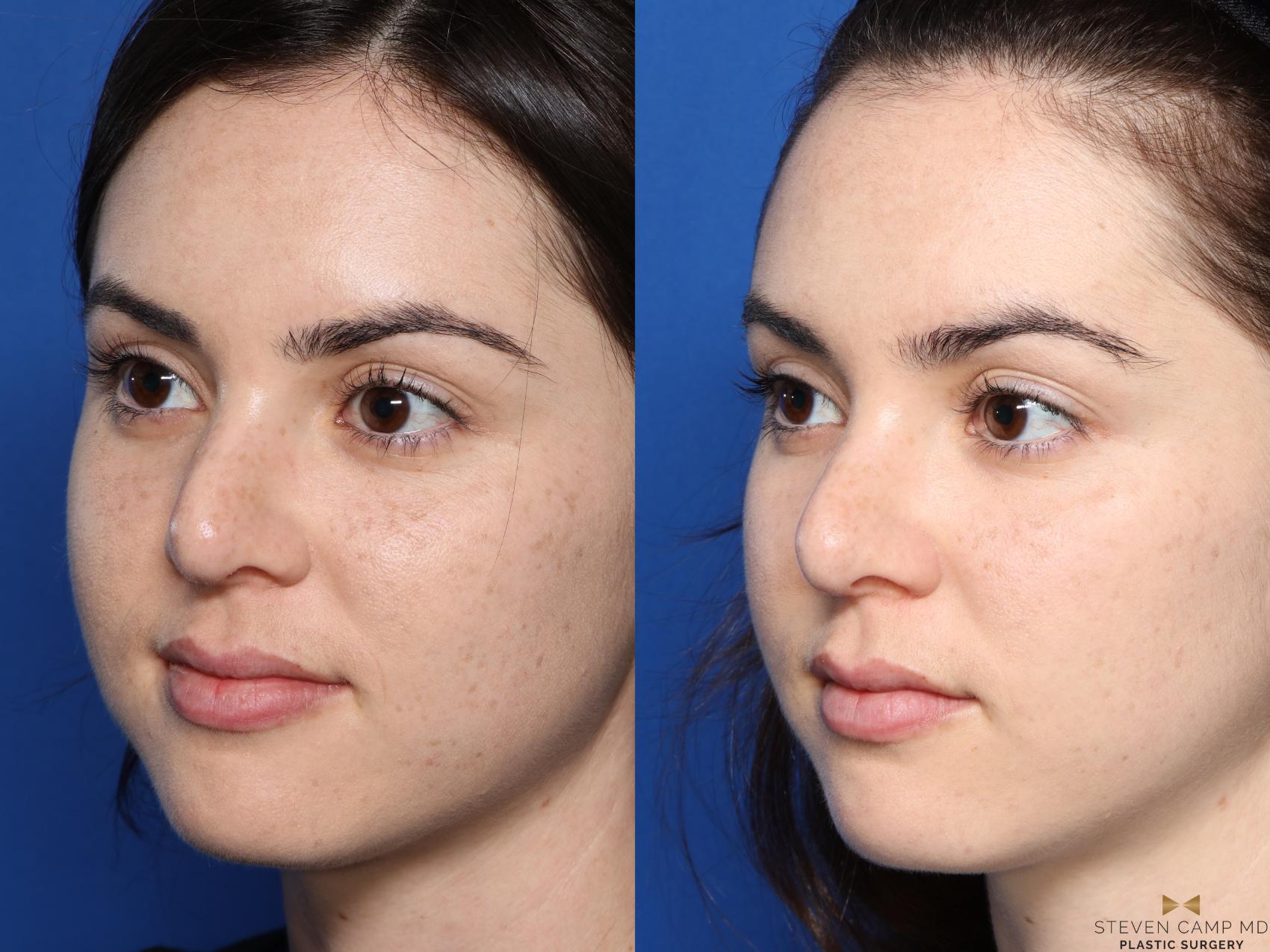 Before & After Sciton Laser Case 337 Left Oblique View in Fort Worth, Texas