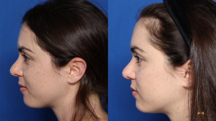 Before & After Sciton Laser Case 337 Left Side View in Fort Worth, Texas