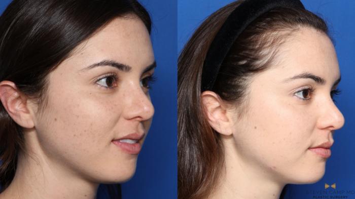 Before & After Sciton Laser Case 337 Right Oblique View in Fort Worth, Texas