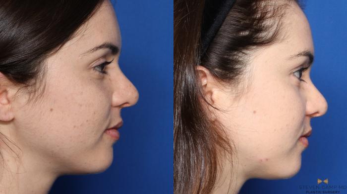 Before & After Sciton Laser Case 337 Right Side View in Fort Worth, Texas