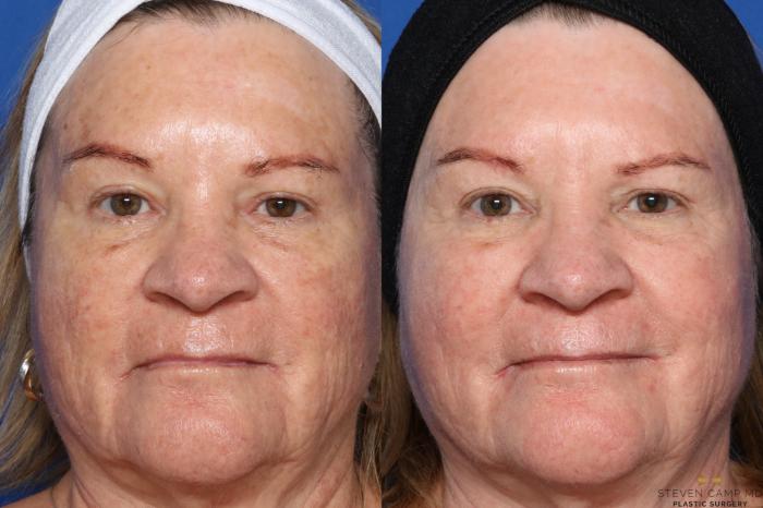 Before & After Sciton Laser Case 358 Front View in Fort Worth & Arlington, Texas