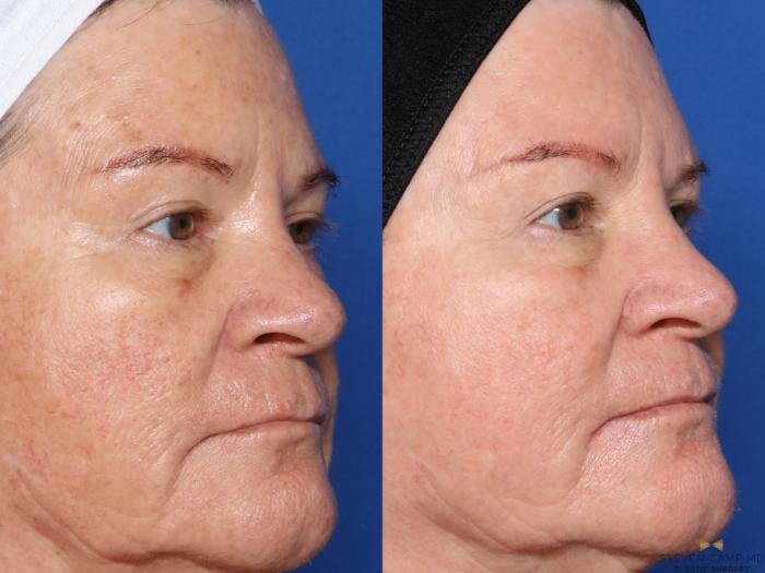 Before & After Sciton Laser Case 358 Left Oblique View in Fort Worth & Arlington, Texas