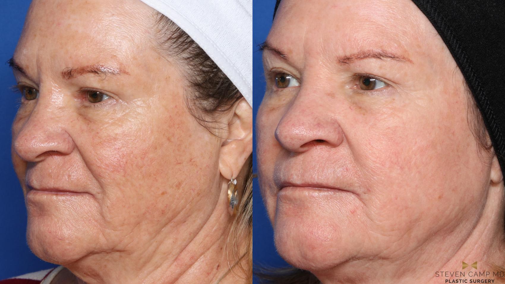 Before & After Sciton Laser Case 358 Right Oblique View in Fort Worth & Arlington, Texas