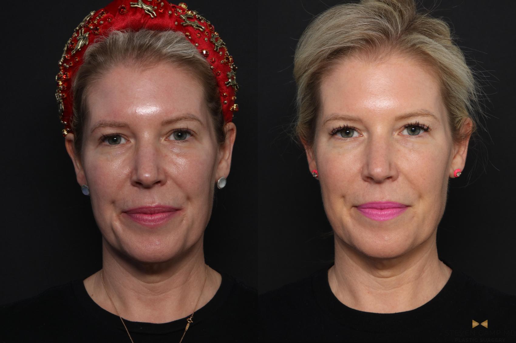 Before & After Sciton Laser Case 389 Front View in Fort Worth, Texas