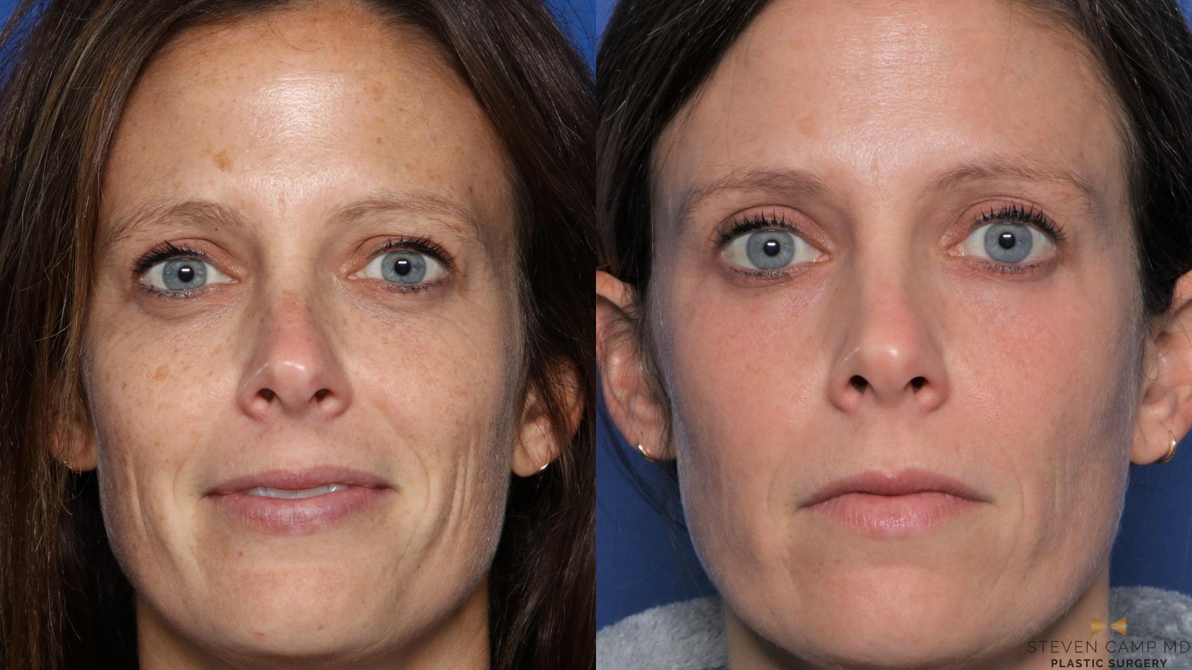 Before & After Sciton Laser Case 443 Front View in Fort Worth, Texas