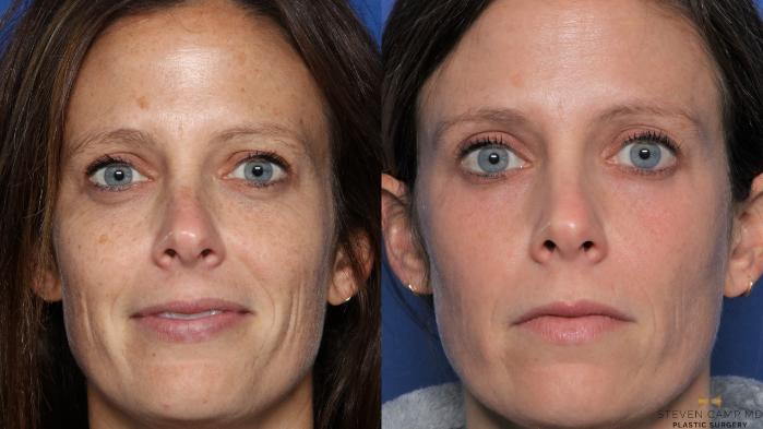 Before & After Sciton Laser Case 443 Front View in Fort Worth & Arlington, Texas