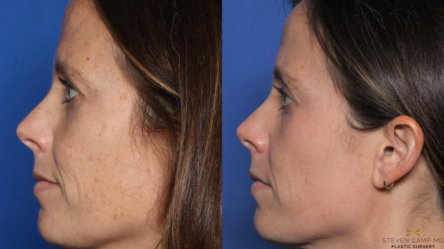 Before & After Sciton Laser Case 443 Left Side View in Fort Worth, Texas