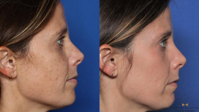 Before & After Sciton Laser Case 443 Right Side View in Fort Worth & Arlington, Texas
