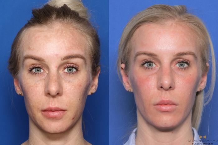 Before & After Sciton Laser Case 445 Front View in Fort Worth, Texas