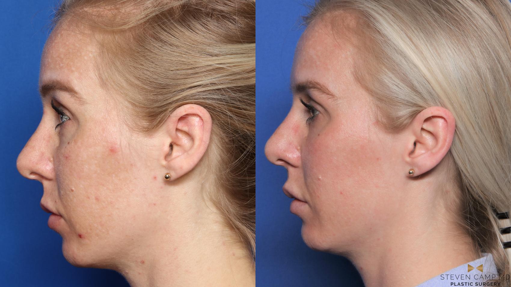 Before & After Sciton Laser Case 445 Left Side View in Fort Worth, Texas