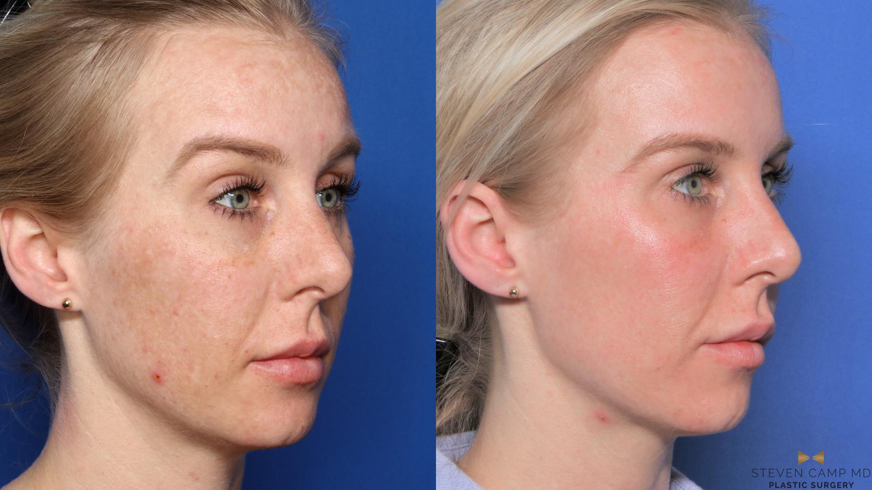 Before & After Sciton Laser Case 445 Right Oblique View in Fort Worth & Arlington, Texas