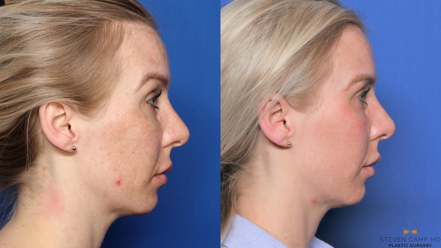 Before & After Sciton Laser Case 445 Right Side View in Fort Worth, Texas